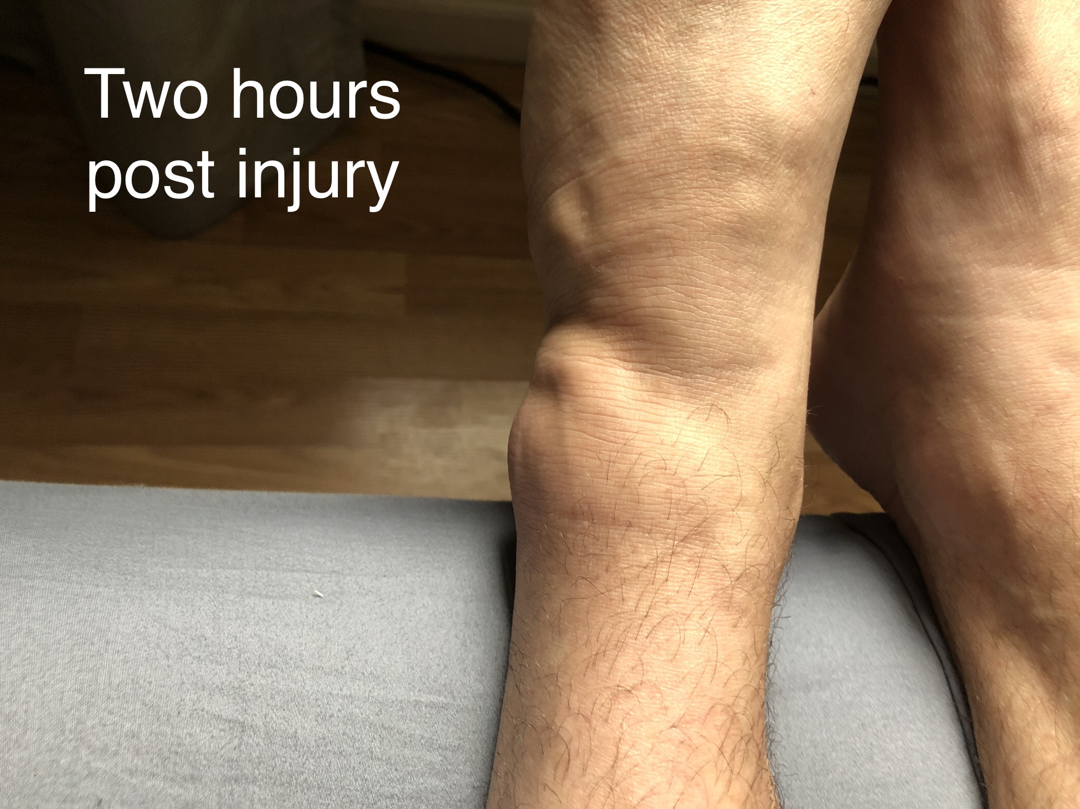 Case Study 11: Iliotibial Band Friction Syndrome - Ankle, Foot and