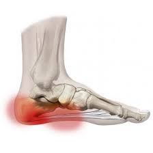 plantar fasciitis is pain on the heel or plantar fascia of the foot